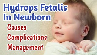 Hydrops Fetalis In Newborn Baby  Fetal Hydrops Causes Complications Treatment amp Prognosis [upl. by Leund]