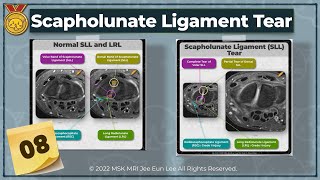 Anatomy08 Scapholunate Ligament Tear Radioscaphocapitate ligament Long radiolunate ligament [upl. by Aryad]