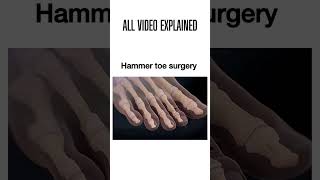 Hammer toe surgery hammertoe footsurgery podiatry foothealth surgeryrecovery [upl. by Asiret313]