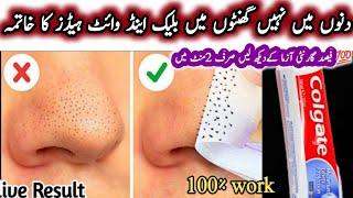 How To Remove BLACKHEADS at Home  In Just 5 Mints Best Way to Remove BLACKHEADS With Toothpaste [upl. by Zoilla]