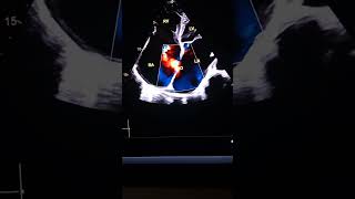 Atrial Septal Defect ASD Apical 4chamber [upl. by Bergstein217]