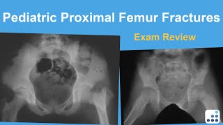 Pediatric Proximal Femur Fractures Exam Review  Lindsay Andras MD [upl. by Anehsat]