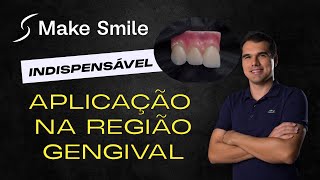 APLICAÇÃO Make Smile na região GENGIVAL LEG  PTBR [upl. by Pascasia]