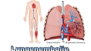 Lungenembolie  Krankheiten der Blutgefäße  Pflege Kanal [upl. by Maxama]
