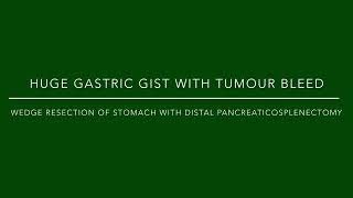 Sleeve gastrectomy with distal pancreaticosplenectomy for Huge gastric GIST [upl. by Moriyama]