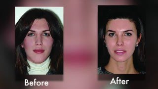 Face to Face Transgender Facial Feminization Plastic Surgery Hot Topics with Rod J Rohrich MD [upl. by Fiester521]