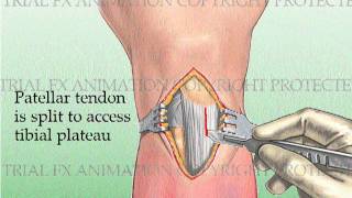 Tibial Fracture repair with Titanium Intramedullary Rod [upl. by Ayaet]