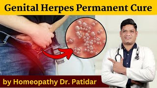 Genital Herpes Permanent Cure by Homeopathy Dr Sunil Patidar genitalherpes [upl. by Notfol244]