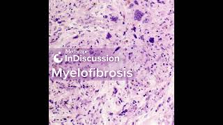 Myelofibrosis Considering TP53 and PostMPN AML [upl. by Longley]