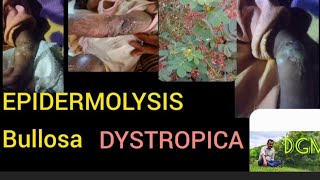 EPIDERMOLYSIS BULLOSA DYSTROPICAAYURVEDA [upl. by Aceissej]