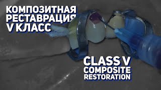 Композитная реставрация по V классу  Composite Restoration V class [upl. by Pitchford]