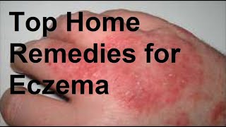 Top Home Remedies for Eczema [upl. by Enilegna]