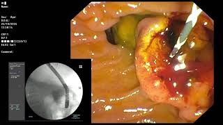 ERCP  Impacted CBD stones removal [upl. by Ahsiat]