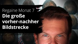 Regaine Monat 7  VorherNachher Vergleich mit Regaine [upl. by Rizas]