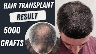 Hair Transplant Before and After  5000 Grafts Result 12 months  Hair Transplant Timelapse [upl. by Orpha]