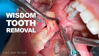 Wisdom tooth removal in 5 MIN or less Surgical Guide Online Course  Free eBook [upl. by Ewen141]