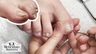 Big Toenail Shape Changing Progress nails satisfying [upl. by Enelrihs]