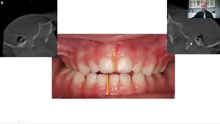 Thumbsucking Open Bite Correction [upl. by Trilbi]