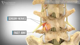 Endoscopic Facet Rhizotomy  Spine Institute of North America [upl. by Llehcear]