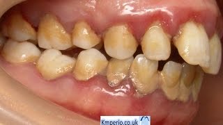 Treatment of Periodontal DiseaseBefore and After [upl. by Janka982]