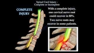 Spinal Cord Injury Complete Or Incomplete  Everything You Need To Know  Dr Nabil Ebraheim [upl. by Samy]