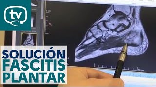 La solución para tratar la fascitis plantar [upl. by Yentruoc691]