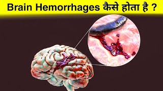 ब्रेन हेमरेज क्या है  ये कैसे होता हैं  how brain hemorrhage occurs [upl. by Weasner]