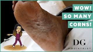 Multiple deep corns with callus whole foot treatment [upl. by Anelat]