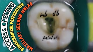 Access Opening in Maxillary Second Molar Biomechanical Preparation  Protaper Rotary Endodontics [upl. by Bathsheba]