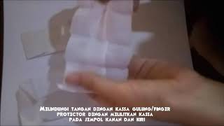 Barton Bandage reposisi dan fiksasi TMJ [upl. by Doreen]