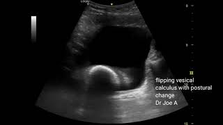 Vesical calculus 2 sonographic case studies of bladder calculi ultrasound video [upl. by Ihab]