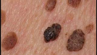 QUERATOSIS SEBORREICA CAUSAS SÍNTOMAS Y TRATAMIENTO DERMATOSIS DE LA PIEL CÓMO QUITAR QUERATOSIS [upl. by Adran]