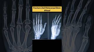 FRACTURE 2nd Metacarpal Bone oF Hand radiographerusn radiography radiographer xray [upl. by Oremo]