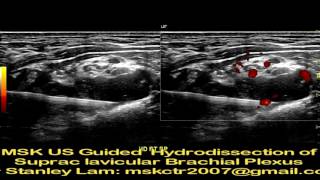 MSK US Guided Hydrodissection of Supraclavicular Brachial Plexus Hydrodissection [upl. by Bevash]