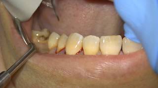 Scaling  Root Surface Debridement with Airpolishing [upl. by Cutlerr]