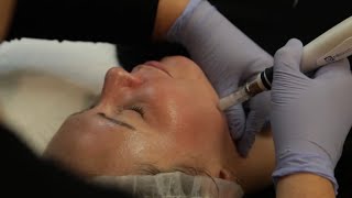 Microneedling Plus PRP  Advanced Dermatology and Laser Institute of Seattle [upl. by Nataline918]