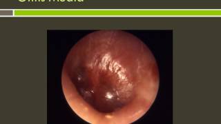 Otitis Externa and Otitis Media [upl. by Mareah464]