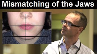 Effect of Midline Discrepancy Mismatching or Facial Asymmetry on Facial Appearance by Dr Mike Mew [upl. by Bibbie]