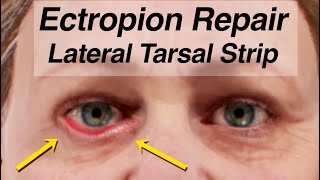 Ectropion Repair Using a Lateral Tarsal Strip Lower Eyelid Drooping After Facial Paralysis [upl. by Marna]