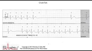 ECG Interpretation Tutorial  ChalkTalk 86  Intermediate Level [upl. by Asyal]