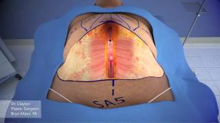 Dr Claytor Demonstrates Drainless Tummy Tuck with Liposuction  3D Animation [upl. by Leggat]