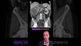 Renal cell carcinoma CT interpretation radiology medicalstudent radiologist radiographer [upl. by Ecirrehs]