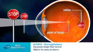 Shortsightedness  What is it  Rose Optometrists explain [upl. by Kincaid]