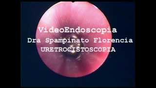 URETROCISTOSCOPIA Emma Neoplasia vesical VideoEndoscopia Dra Spampinato Florencia [upl. by Tnecniv]