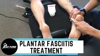 Plantar Fasciitis Treatment San Diego Graston Chiropractic [upl. by Selena99]