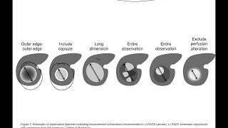 LIRADS Radiology 2018 Jan [upl. by Enelaehs]