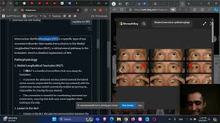 Neurology and Ophthalmology InterNuclear Ophthalmoplegia INO MLF lesion [upl. by Rojam990]