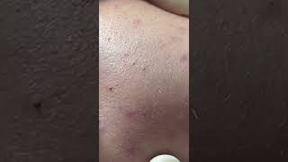 BLACKHEAD acne acnetherapy acnetreatment antiacne [upl. by Theola]