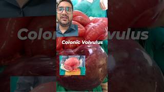 Colonic Volvulus I Sigmoid Volvulus treatment in Delhi Noida [upl. by Isbel]