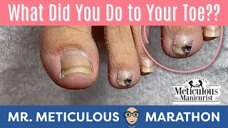 How to Pedicure an Ingrown amp Impacted Toenail PainMrMeticulousMarathon [upl. by Kung]